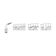 INSERT UP6 POUR CHIRURGIE COMPATIBLE MECTRON - WOODPECKER